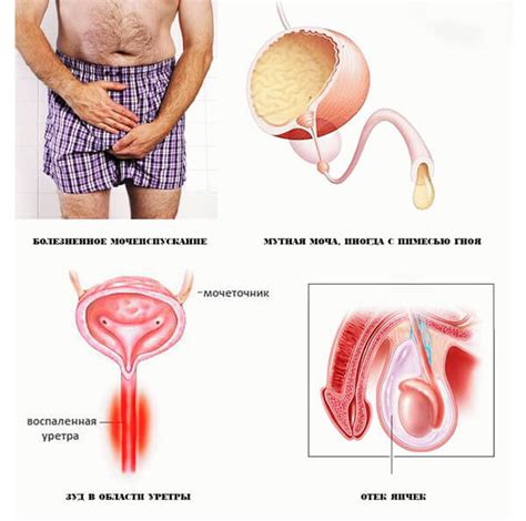 Хламидиоз у мужчин симптомы и лечение препараты последствия первые признаки