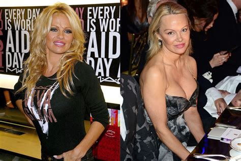 Pamela Anderson’s New Plastic Surgery Why She Looks Fresh