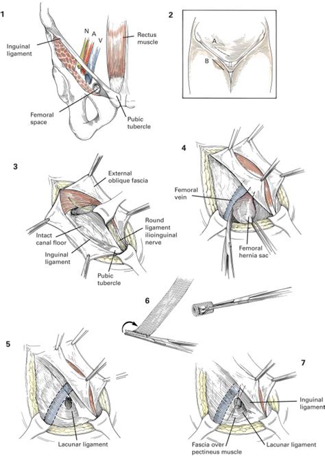 femoral hernia repair treatment getwellgo india s best healthcare