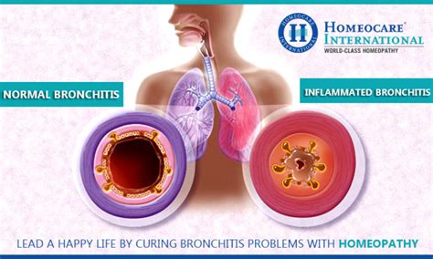 overcome bronchitis and its effects with homeocare international treatment