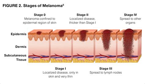 melanoma pictures  stages stage      melanoma pictures