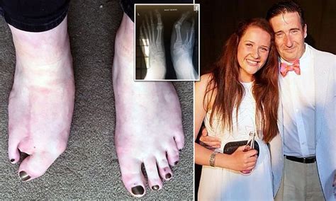 rare form of gigantism leaves matilda carnegie with two toes on her