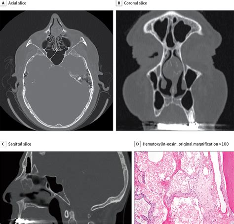 mass   anterior nasal septum radiology jama otolaryngology