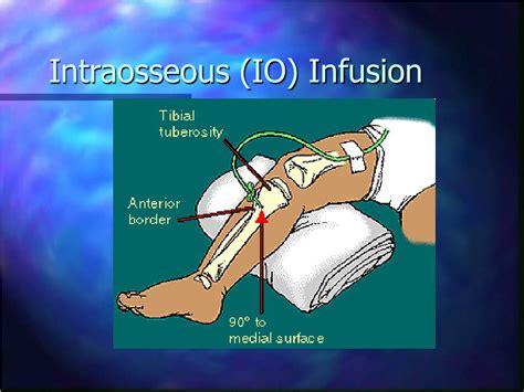 intravenous therapy powerpoint    id