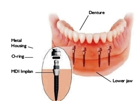 dental implant parts diagram wiring diagram