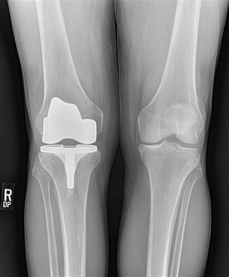 knee replacement  buyxraysonline