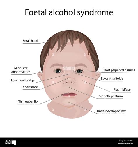 fetales alkoholsyndrom fotos und bildmaterial in hoher auflösung alamy