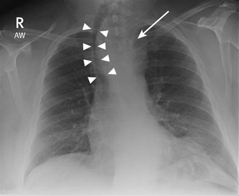 abnormal chest radiograph  bmj