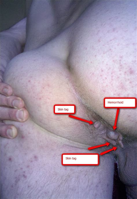 Anal warts pain surgery