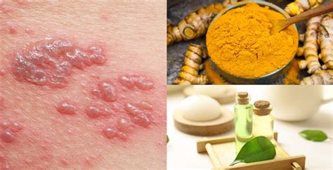 lichen planus  natural ways  treat  nasty rash