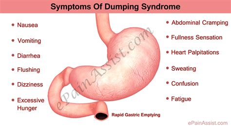 dumping syndrome treatment symptoms  facts diet diagnosis