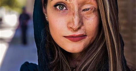 Marzieh A Victim Of A 2014 Acid Attack In Isfahan Iran Photo By