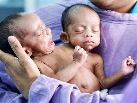 conjoined twins warning graphic images cbs news