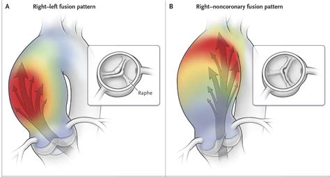 Aortic Dilatation In Patients With Bicuspid Aortic Valve Nejm