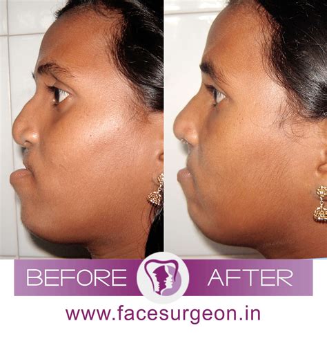 essential corrective surgery   jaw protrusion  india