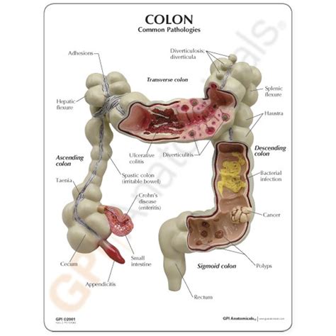 colon model  common pathologies  colon anatomy model gpi