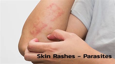 skin rashes parasites uatekacom