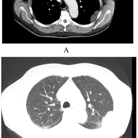 Axial Ct Scan Of Left Upper Lobe Mass Mediastinal Window Panel A And