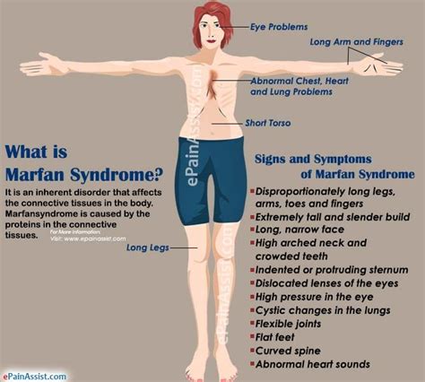 Marfan Syndrome Heart