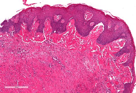 pathology outlines lichen sclerosus balanitis xerotica obliterans