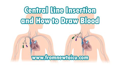 central  insertion    draw blood    icu