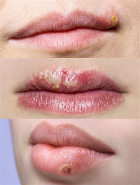cold sores transmission symptoms and treatment