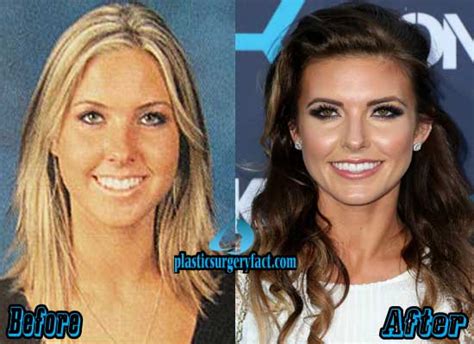 Audrina Patridge Plastic Surgery Before And After