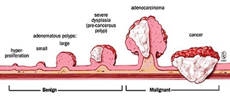 Progression From Polyp To Cancer Download Scientific Diagram
