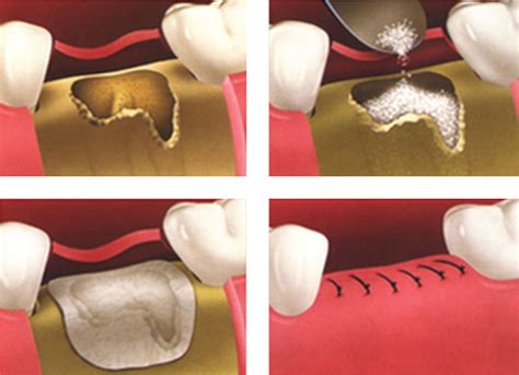 bone grafting morgan lemke periodontics dental implants
