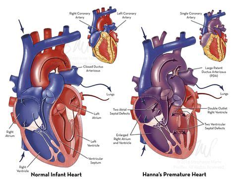 heart defects legal board heart defect illustration