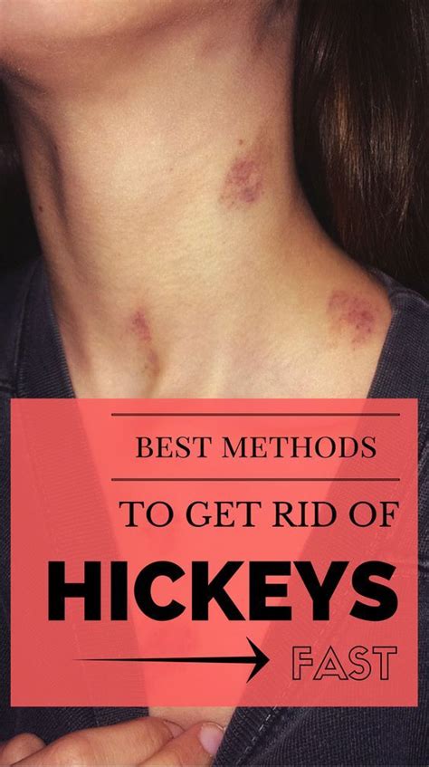 here are best methods to get rid of hickeys fast