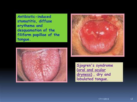 ppt tougue disorders powerpoint presentation free download id 6719147