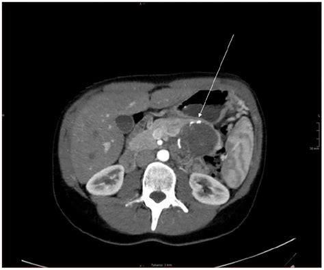 Solid Pseudopapillary Neoplasm Of The Pancreas Clinical Pathological