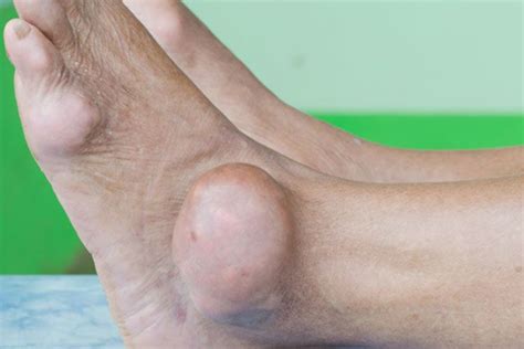 What Is Gout Causes Symptoms And Treatment