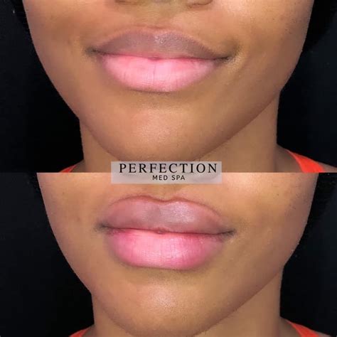 261 likes 11 comments lip fillers collective lipfillerscollective