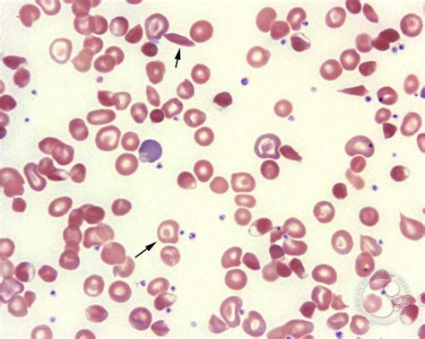 pbs peripheral blood smear thalassemia trait stock photo  xxx hot girl
