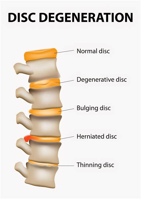 july focus spinal disc problems  rivermead osteopaths