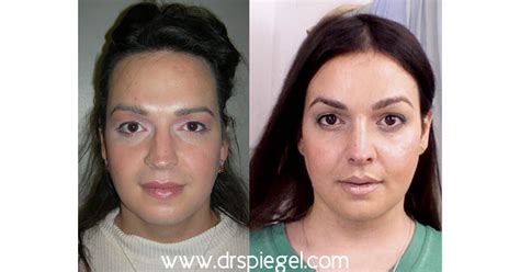 9 sex reassignment surgery a transgender woman who is also transgender surgeries male to