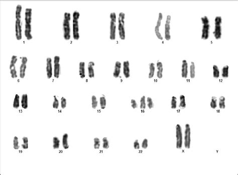 9 Karyotype Showing Trisomy 47 Xx 16 Download Scientific Diagram