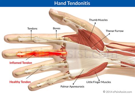 hand tendonitiscausesrisk factorssymptomstreatment
