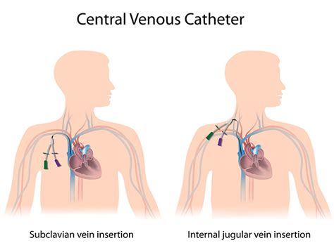 Liver Cancer Treatment Options Tunneled Central Catheters
