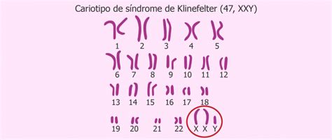 Síndrome De Klinefelter 47 Xxy Causas Características Y Síntomas