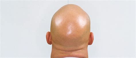 Why Are Bald Heads So Shiny When The Skin Elsewhere On Your Body Isn T