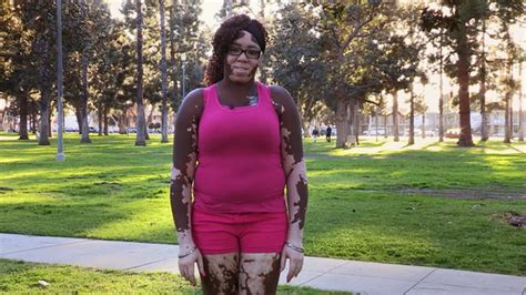 skin condition leaves woman   skin colors body bizarre discovery life