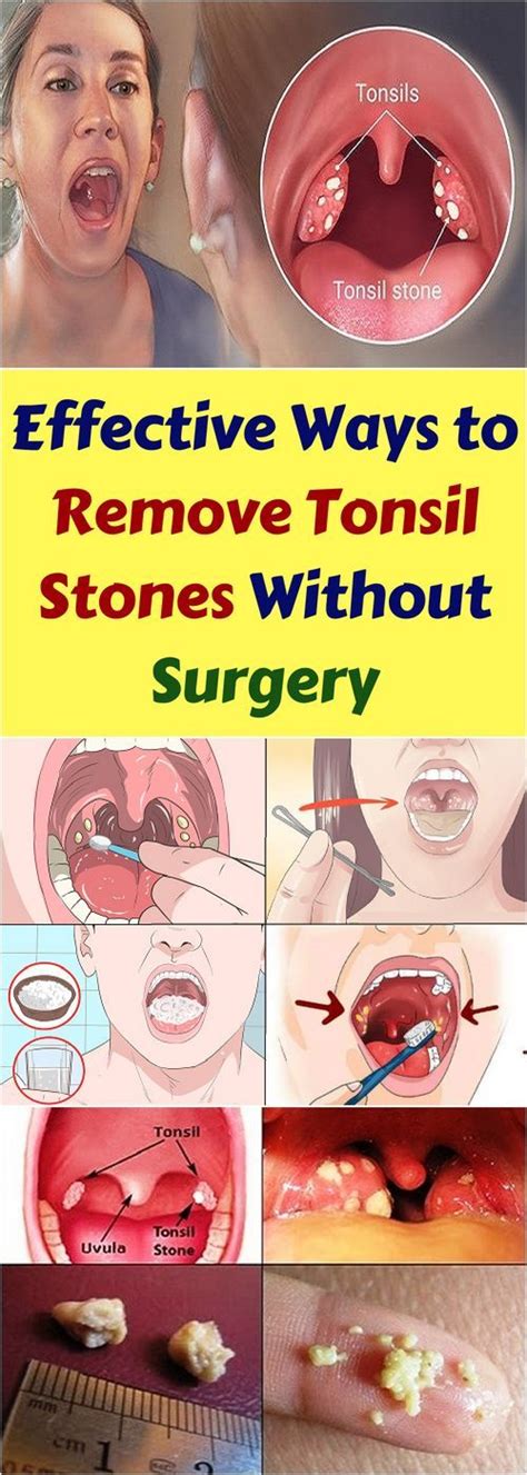 start slim today effective ways  remove tonsil stones