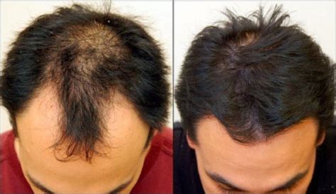 treatment  hair grow info healthinfo health