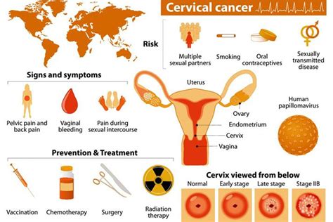 cervical cancer a forgotten tragedy hivos