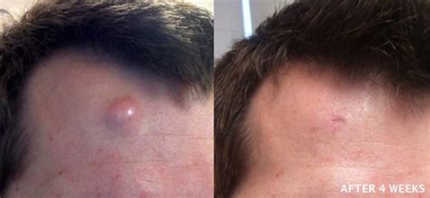 cyst removal results photos skin surgery laser clinic london bristol