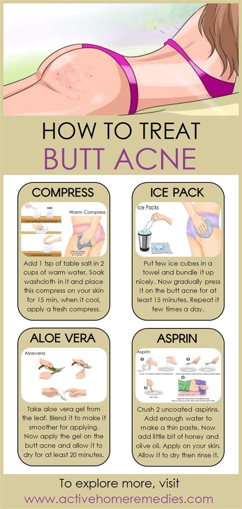 How To Treat Butt Acne Naturally Active Home Remedies