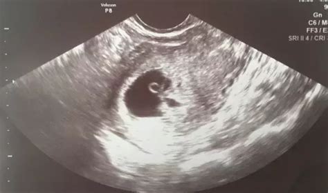 6 week ultrasound heartbeat